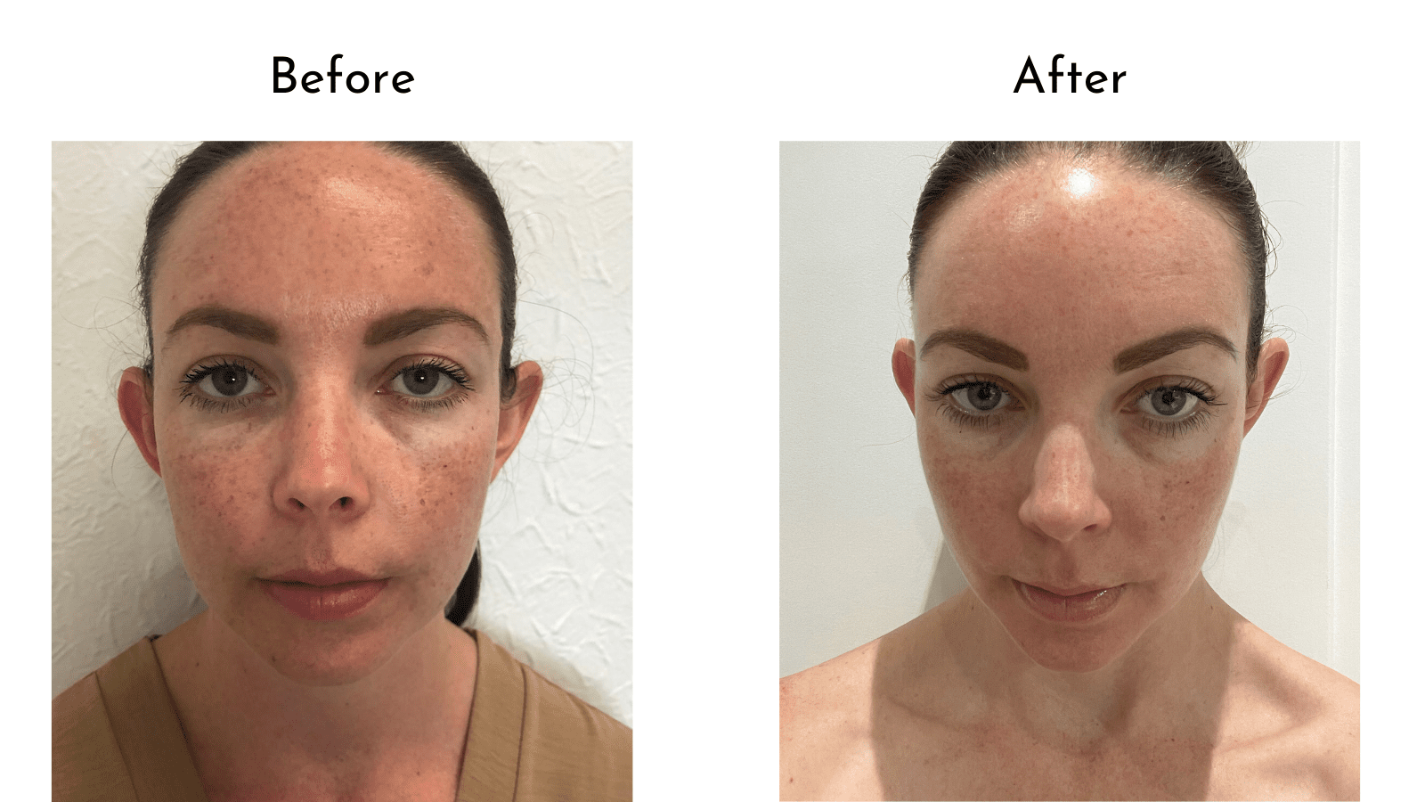 Hyperpigmentation Treatment
