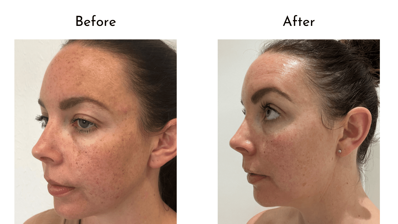 Hyperpigmentation Treatment My Journey to Beautiful Skin