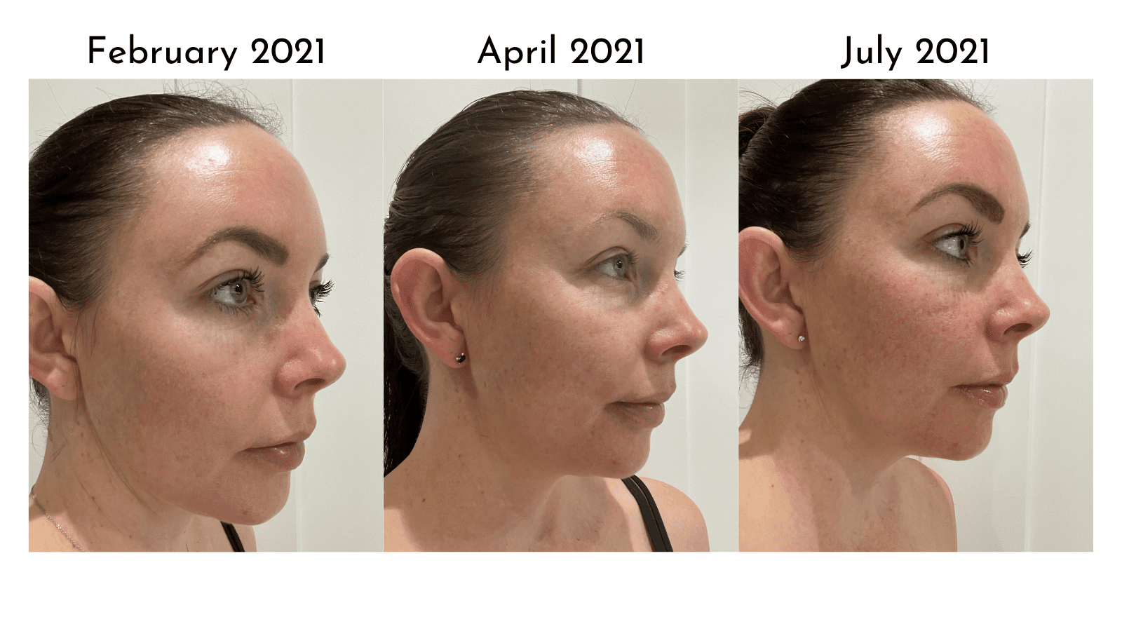 Hyperpigmentation Treatment My Journey to Beautiful Skin